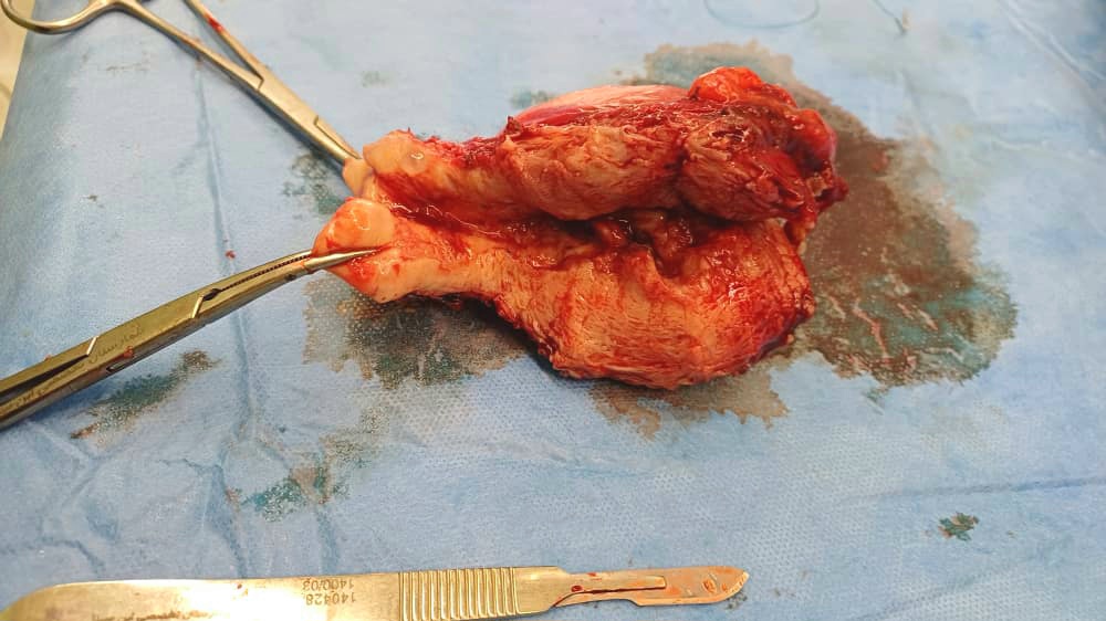 جراحی سرطان اندومتر