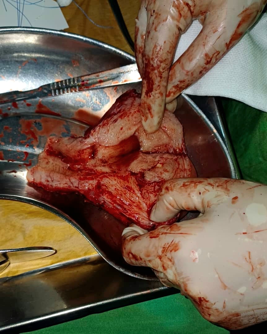 جراحی سرطان رحم