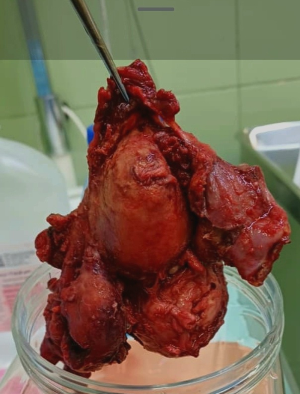 الأورام الليفية المتعددة في الرحم