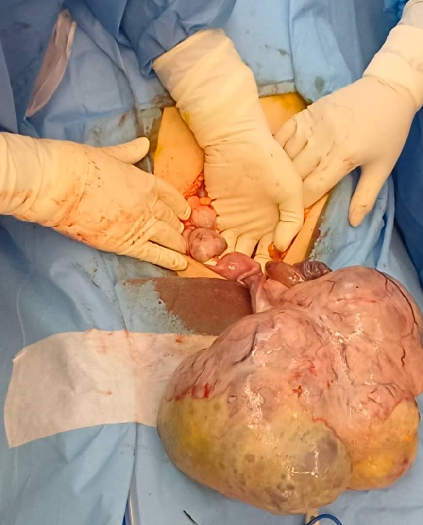 جراحی تخمدان برای برداشتن توده سرطانی