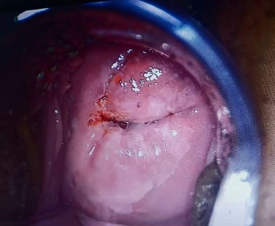 ضایعه سرویکس ناشی از HPV پرخطر قبل از لیزر