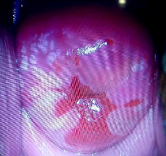 أخذ عينات وفحص نسيج عنق الرحم - كولبوسكوبي