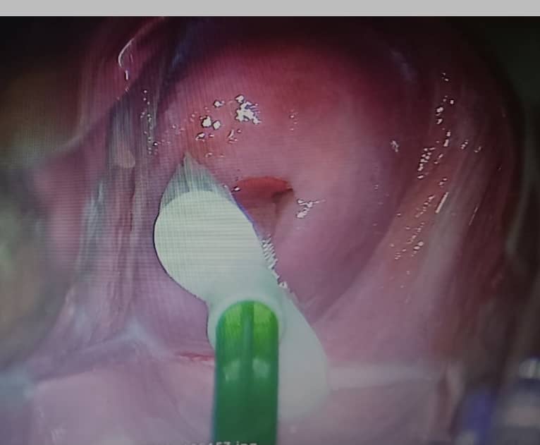 اختبار مسحة عنق الرحم في عيادة الدكتورة مريم معتمدي‌نسب فلوشيپ اونكولوژی زنان