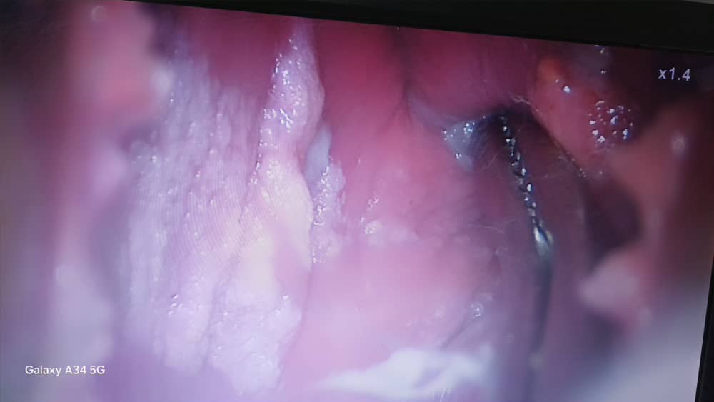 آنوسکوپی برای ضایعات HPV