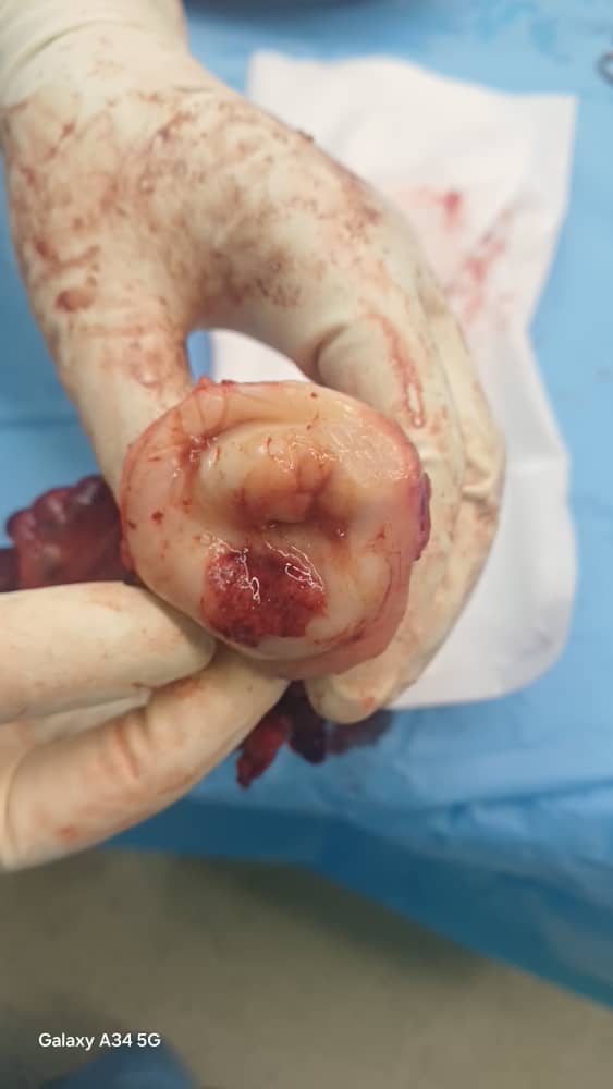 ظاهر سرطان دهانه رحم