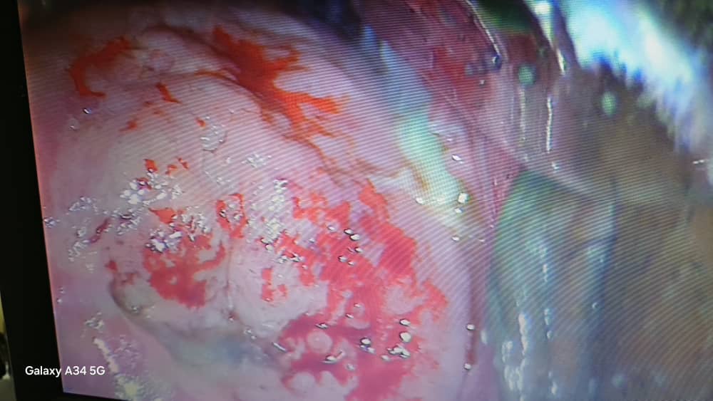 سرطان سرویکس