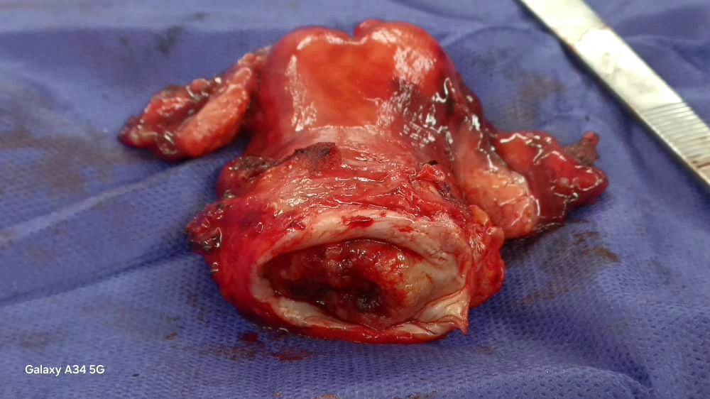 هیسترکتومی رادیکال در سرطان دهانه رحم در بیمار ۴۷ ساله