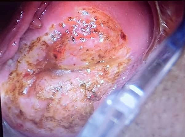 بهبود سرویکس پس از لیزردرمانی