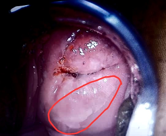 ضایعه پرخطر ویروس HPV در دهانه رحم