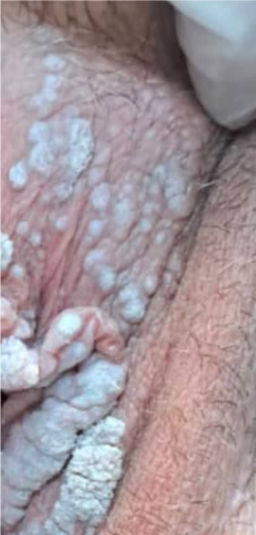 تست HPV و زگیل تناسلی