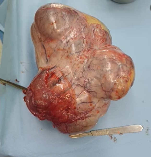 سرطان تخمدان