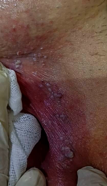 ضایعه وارت ولو قبل از درمان