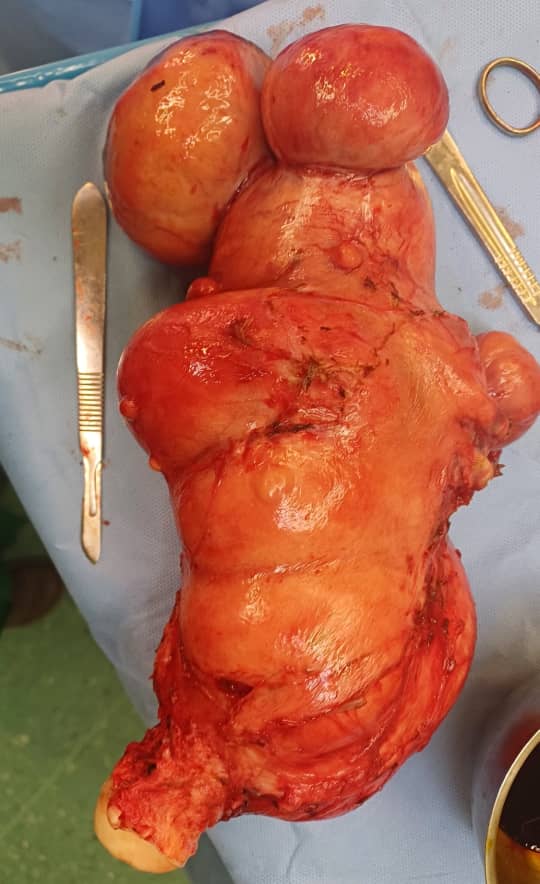 رحم مع أورام ليفية متعددة في جراحة سرطان النساء طهران