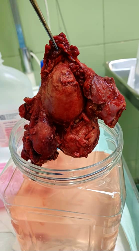 رحم با میومهای متعدد در جراحی سرطان زنان تهران